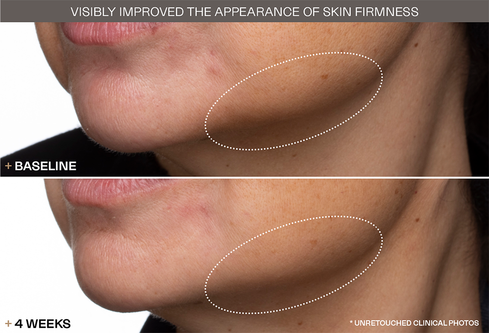 Skin Firmness