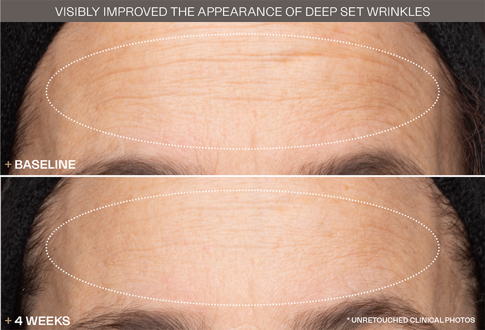 Set Wrinkles