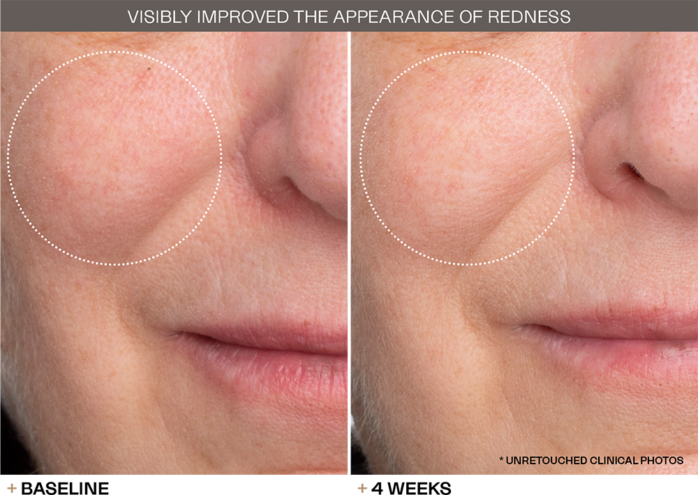 Appearance Redness