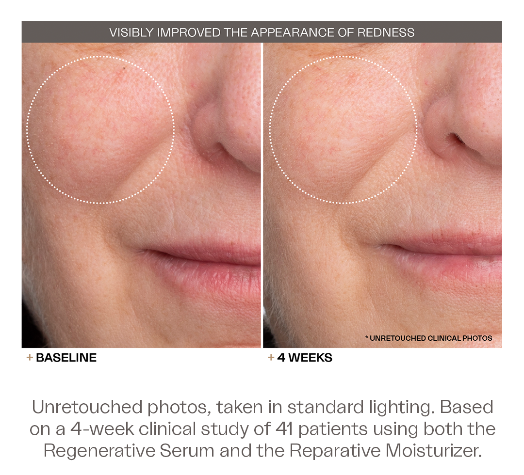 The Discovery Duo visibly improved the appearance of deep set wrinkles. Unretouched photos, taken in standard lighting. Based on a 4-week clinical study of 41 patients using both the Regenerative Serum and the Reparative Moisturizer.