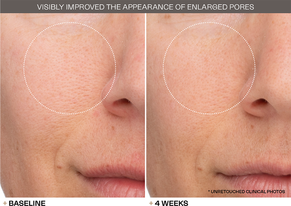Enlarged Pores