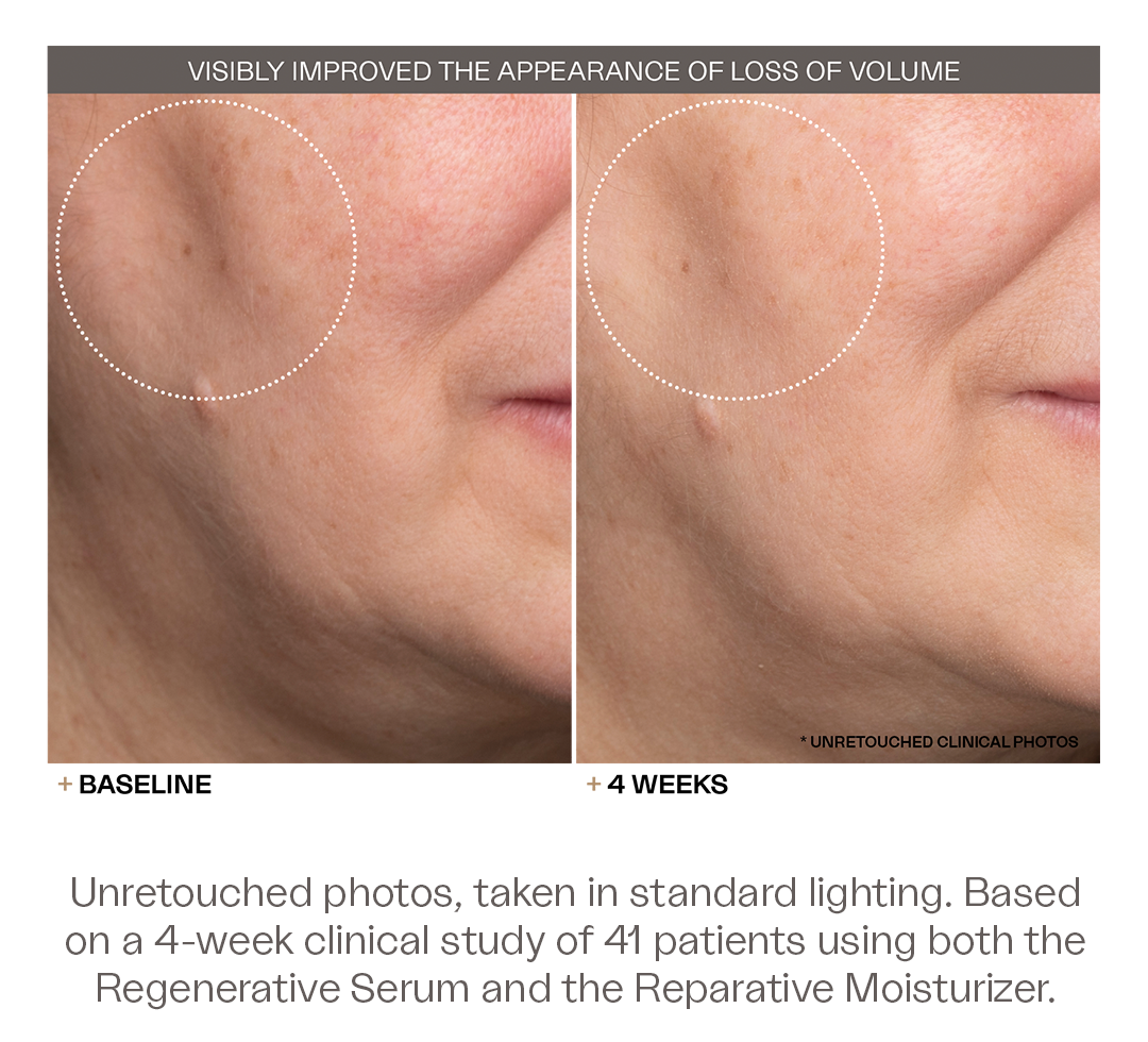 The Discovery Duo visibly improved the appearance of deep set wrinkles. Unretouched photos, taken in standard lighting. Based on a 4-week clinical study of 41 patients using both the Regenerative Serum and the Reparative Moisturizer.