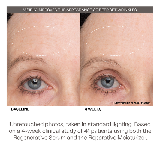 The Discovery Duo visibly improved the appearance of deep set wrinkles. Unretouched photos, taken in standard lighting. Based on a 4-week clinical study of 41 patients using both the Regenerative Serum and the Reparative Moisturizer.