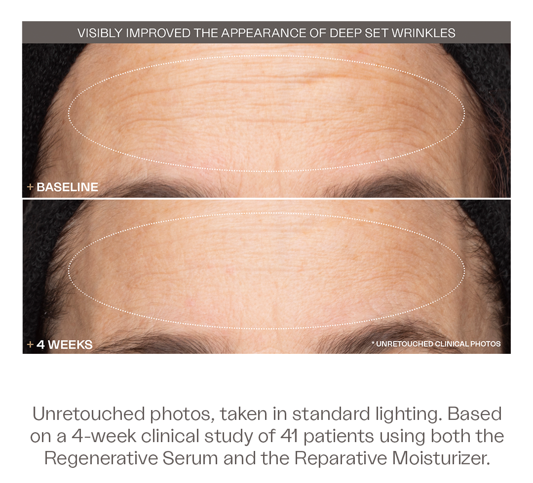 The Discovery Duo visibly improved the appearance of deep set wrinkles. Unretouched photos, taken in standard lighting. Based on a 4-week clinical study of 41 patients using both the Regenerative Serum and the Reparative Moisturizer.
